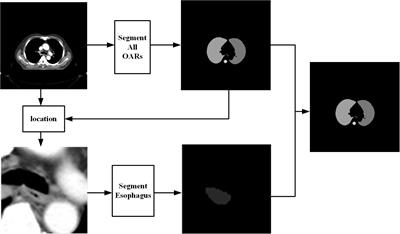 Applying a novel two-step deep learning network to improve the automatic delineation of esophagus in non-small cell lung cancer radiotherapy